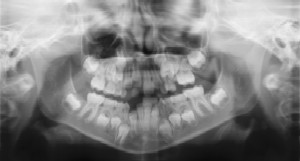 Dental Radiographs (X-Rays) - Pediatric Dentist in San Angelo, TX