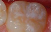 Sealant-After - Pediatric Dentist in San Angelo, TX